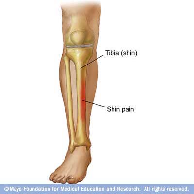 Shin Splints (for Parents)